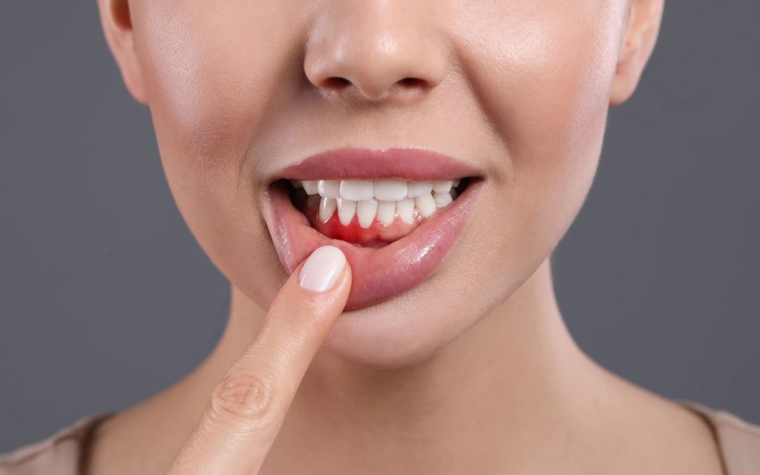 Encías inflamadas: Causas, tratamientos y síntomas