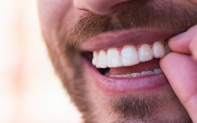 Ataches en ortodoncia invisible, ¿qué son y por qué son importantes?