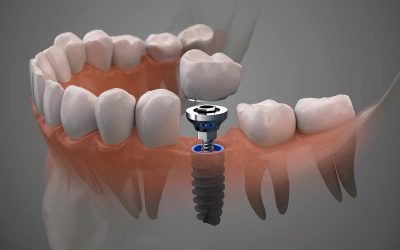 ¿Cuánto Tardan en Cicatrizar los Implantes Dentales? Tiempos y Cuidados