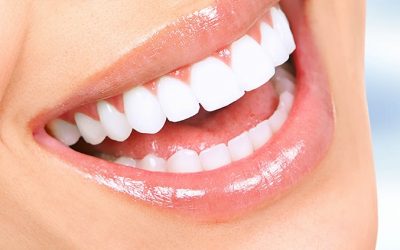 Carillas : lo último en estética dental