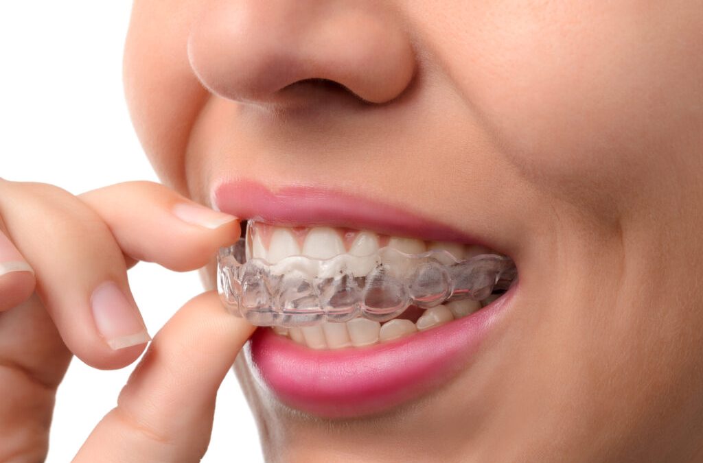 ¿Cuál es el precio de la ortodoncia invisible ?