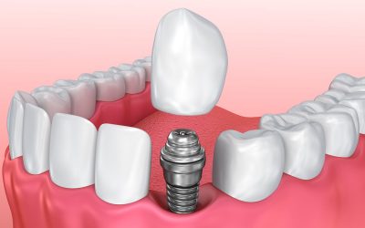 Implantes dentales con corona