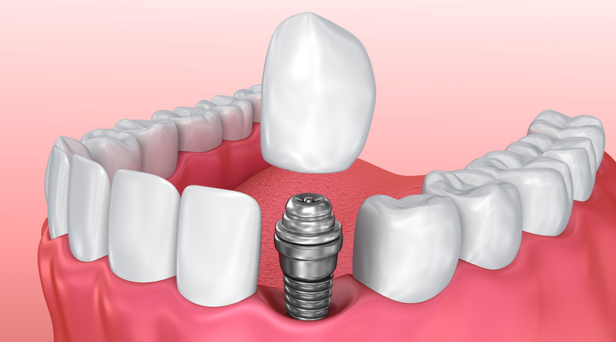 implantes dentales con corona