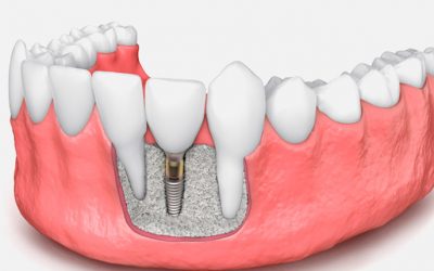 ¿Qué es un injerto de hueso en odontología?