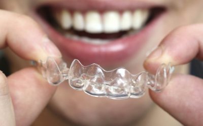 ¿Cuánto dura un tratamiento de ortodoncia invisible?