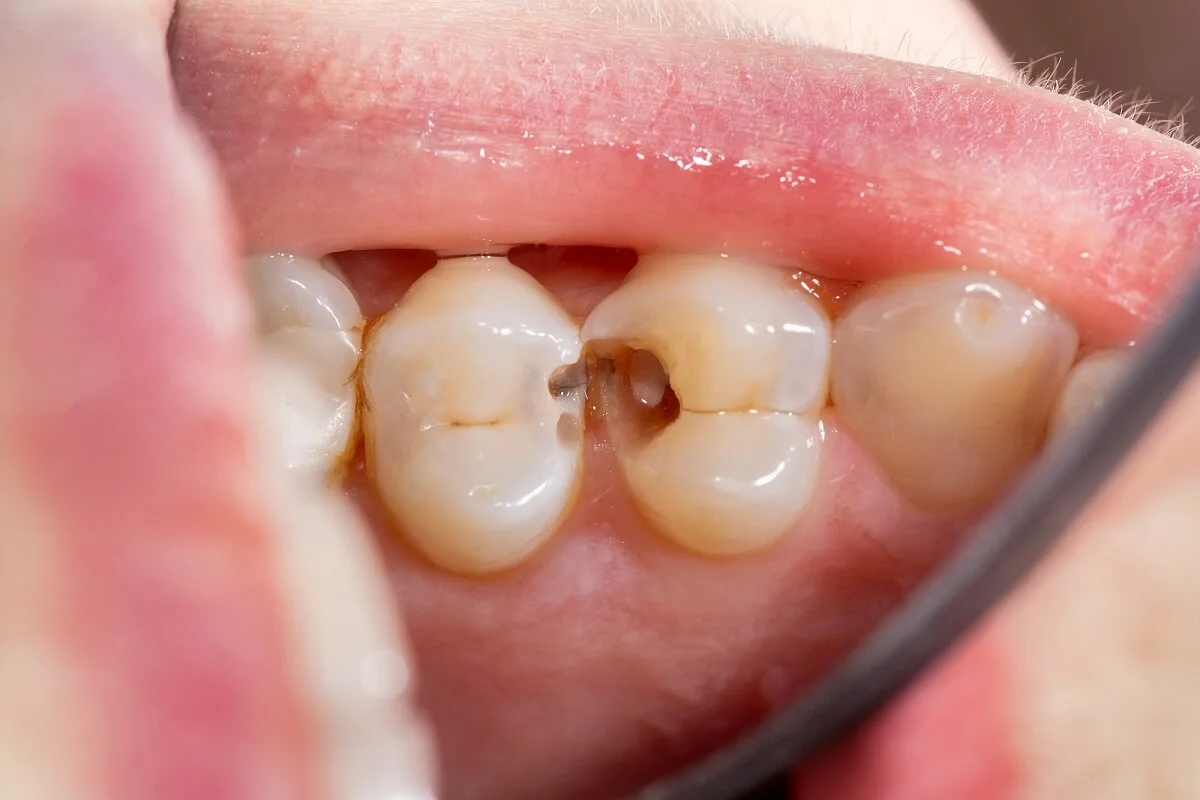 Cuanto dura un tratamiento de ortodoncia invisible