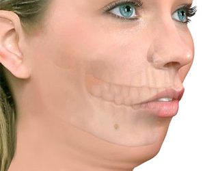 Retrognatia: Causas, síntomas y tratamientos para corregir la mandíbula retraída